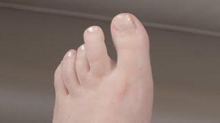 How to Treat an Ingrown Toenail | WebMD