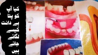 how teeth are fitted دانت کیسے لگائے جاتے ہیں