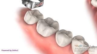 Tooth Separator - Elastic - Orthodontic Treatment