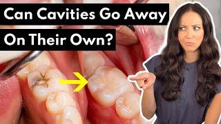 Wait, Can Cavities Go Away on Their Own? (Incipient Decay Explained)