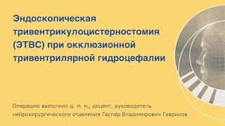 Эндоскопическая тривентрикулоцистерностомия (ЭТВС) при окклюзионной тривентрилярной гидроцефалии