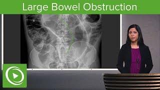 Bowel Obstruction and Ileus: Large Bowel Obstruction & Ogilvie Syndrome – Radiology | Lecturio