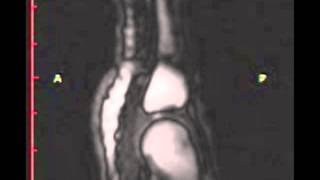 Real-time MRI of joint cracking