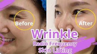 RF Skin Tightening | RF Wrinkle Removal | Wrinkle Reduction| Skin Tightening | 32J3 myChway