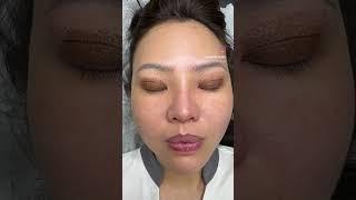 Fixing previous eyelid surgery by plasma by Hannah