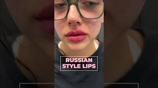 Botox and Lip fillers in LA at Skin Tightening, Botox and Lip Fillers by Skinsation LA