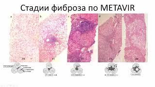 Эхосемиотика диффузных изменений печени.  Часть 1. Цирроз печени