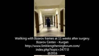 Walking with Ilizarov frame 11 weeks after genu varus correction