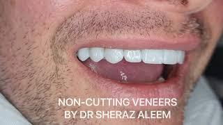 Outstanding Full Arch Veneers. Zero Damage to natural teeth