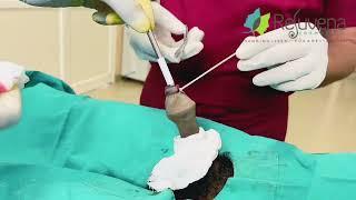 Successful Circumcision Procedure by Dr. Deepesh Goyal at Rejuvena Cosmo Care