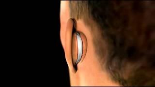 Ear Plastic Surgery - 3D Medical Animation || ABP ©