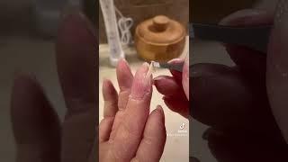 Finger peeling with palmoplantar keratoderma hand callus EPPK - Apr 6, 2023