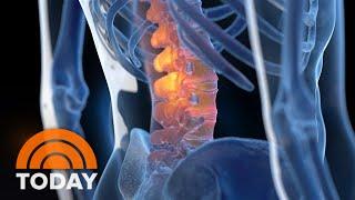 New therapy aims to cure back pain without drugs, surgery