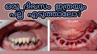 ഒരു ദിവസം ഇത്രേം പല്ലൊക്കെ എടുക്കാമോ? | Multiple teeth Extraction of teeth Dr Ajina Salim Dentaltalk