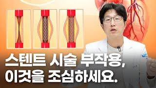 심장질환 중 협심증 치료, 막힌 혈관을 뚫어주는 스텐트 시술의 부작용을 미리 알고 치료받자!!