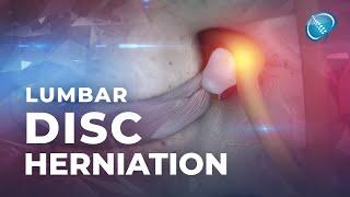 What is Lumbar Disc Herniation? | Herniated Disc