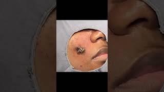 A deceivingly cheeky cyst ️️ #drpimplepopper #popaholics #oddlysatisfying