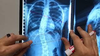 How To Measure Scoliosis Cobb Angle Without Complex Tools