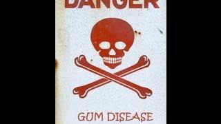 What is Gum Disease?