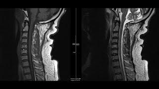 Noncontrast MRI cervical spine search pattern