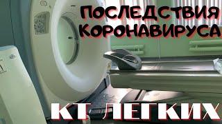 ПОСЛЕДСТВИЯ КОРОНАВИРУСА КТ ЛЕГКИХ - какое ПОРАЖЕНИЕ⁉️ ПНЕВМОНИЯ  МОЖНО ли СНОВА ЗАРАЗИТЬСЯ⁉️