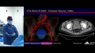 Transradial Prostate Artery Embolization (PAE) for Symptomatic BPH