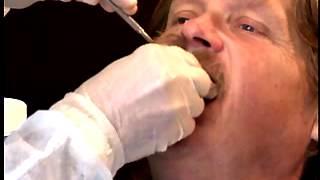 Complete Denture Procedure ; 01 Maxillary Preliminary Impression