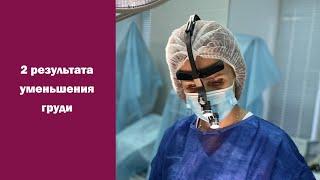 Уменьшение груди - сразу 2 результата из операционной