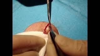 Skin surgery - epidermoid (sebaceous) cyst removal 2