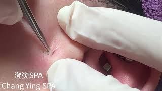 桃園中壢清粉刺  臉頰黑頭清除 Blackheads on face Removal！