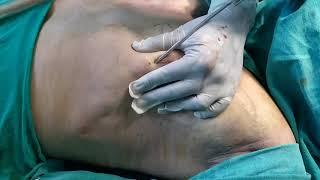 Gynecomastia Surgery At Bliniq Cosmetic Surgery Centre I Dr Ashwani Kumar , Plastic surgeon