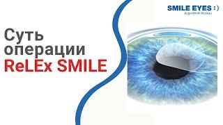 ReLEx SMILE - суть операции лазерной коррекции зрения по методу СМАЙЛ