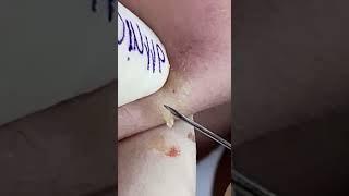 Pimple Popping, Ingrown Hair Removal & Blackheads removal very satisfying