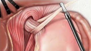 PreOp® Hiatal Hernia – Laparoscopic 