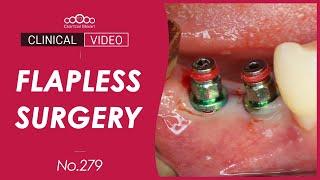 #45, 46 Implant placement with Flapless surgery [Dr. Cho Yongseok]