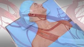 TCAR or transcarotid artery revascularization procedure