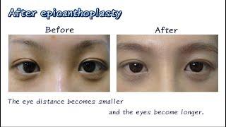 Lih-Ren Clinic - Epicanthoplasty and Outside fold