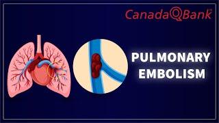 Pulmonary Embolism