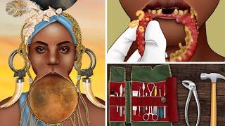 ASMR Pimple popping lip plates for the Mursi tribes woman | Treatment animation