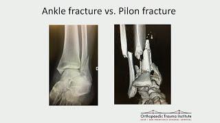 Treatment of Common Geriatric Fractures: Knee and Ankle