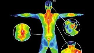 Thermal Imaging ... Cutting Edge Screening Tool for Detecting Inflammation