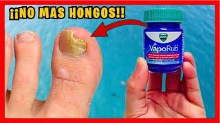 How to COMPLETELY REMOVE nail fungus with HOME REMEDY 4k | Gio de la Rosa