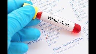 Microbiology  - Interpretation of Widal Test @Labsforlifeproject