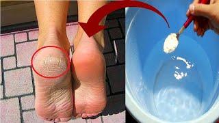 Get Rid of CRACKED HEELS Permanently! | How to Treat Cracked Heels At Home