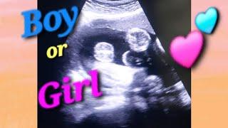 Placenta posterior means boy🩵 or girl🩷 | Placenta fundoposterior meaning | Baby gender prediction