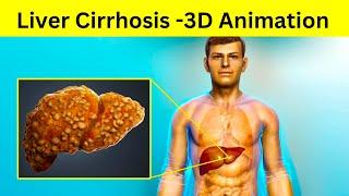 लिवर ख़राब कैसे होता हैं ? Liver Cirrhosis कैसे होता हैं ?