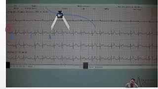 How to  interpret group beating in ECG