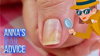 Nail Separation | Causes | Early Treatment of Onycholysis [Anna's Nail Advice]