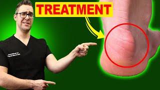 Haglund's Deformity & Haglund's Bump Treatment [Exercises & Stretching]