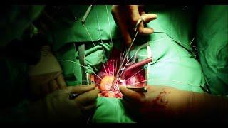 Open Heart Surgery: Aortic Valve Replacement from a Medical Student’s Perspective